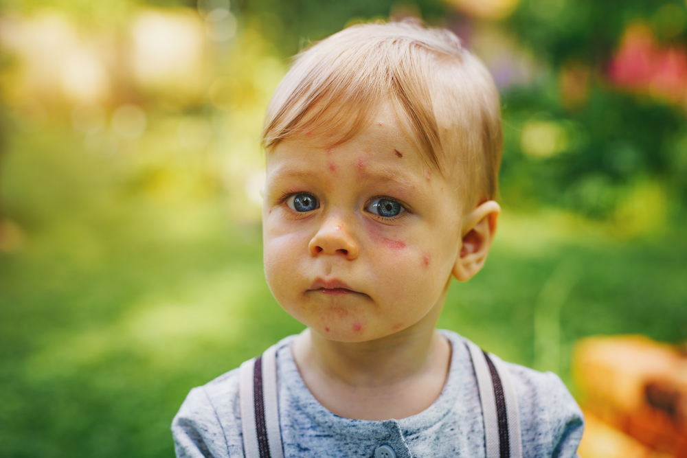 When Should You Seek Urgent or Emergency Care for a Bug Bite?