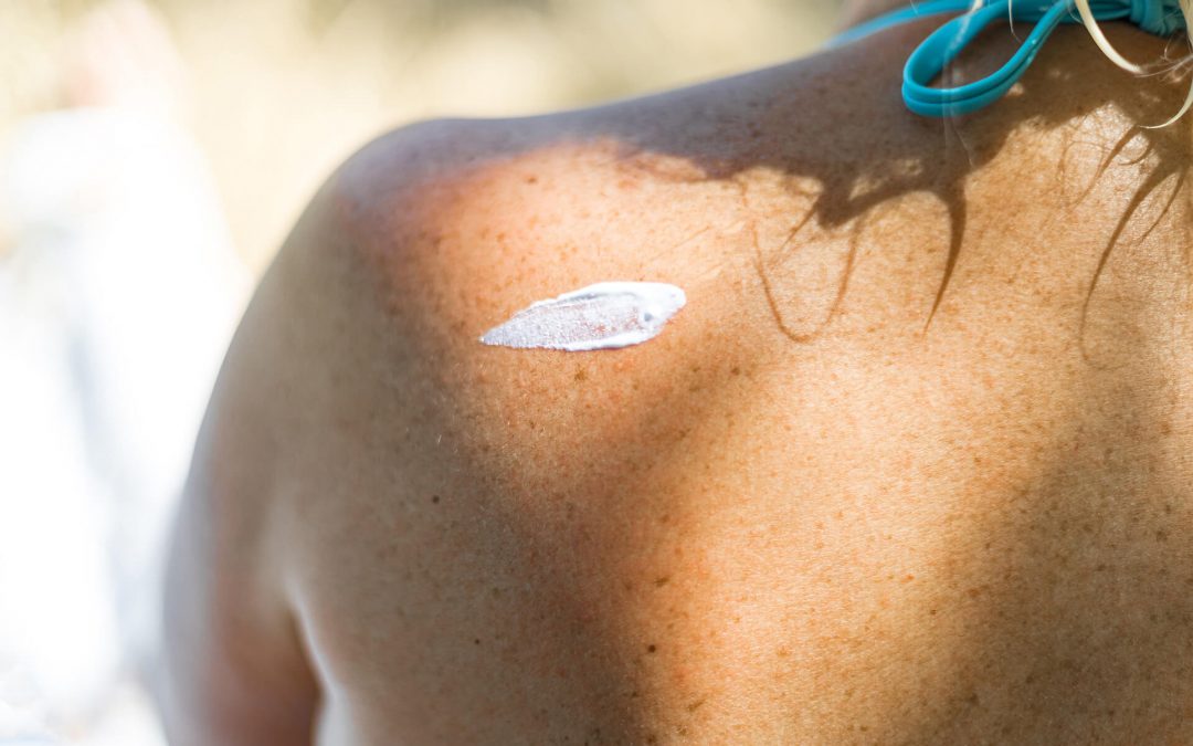 Skin Cancer Prevention Tips and Warning Signs You Should Know
