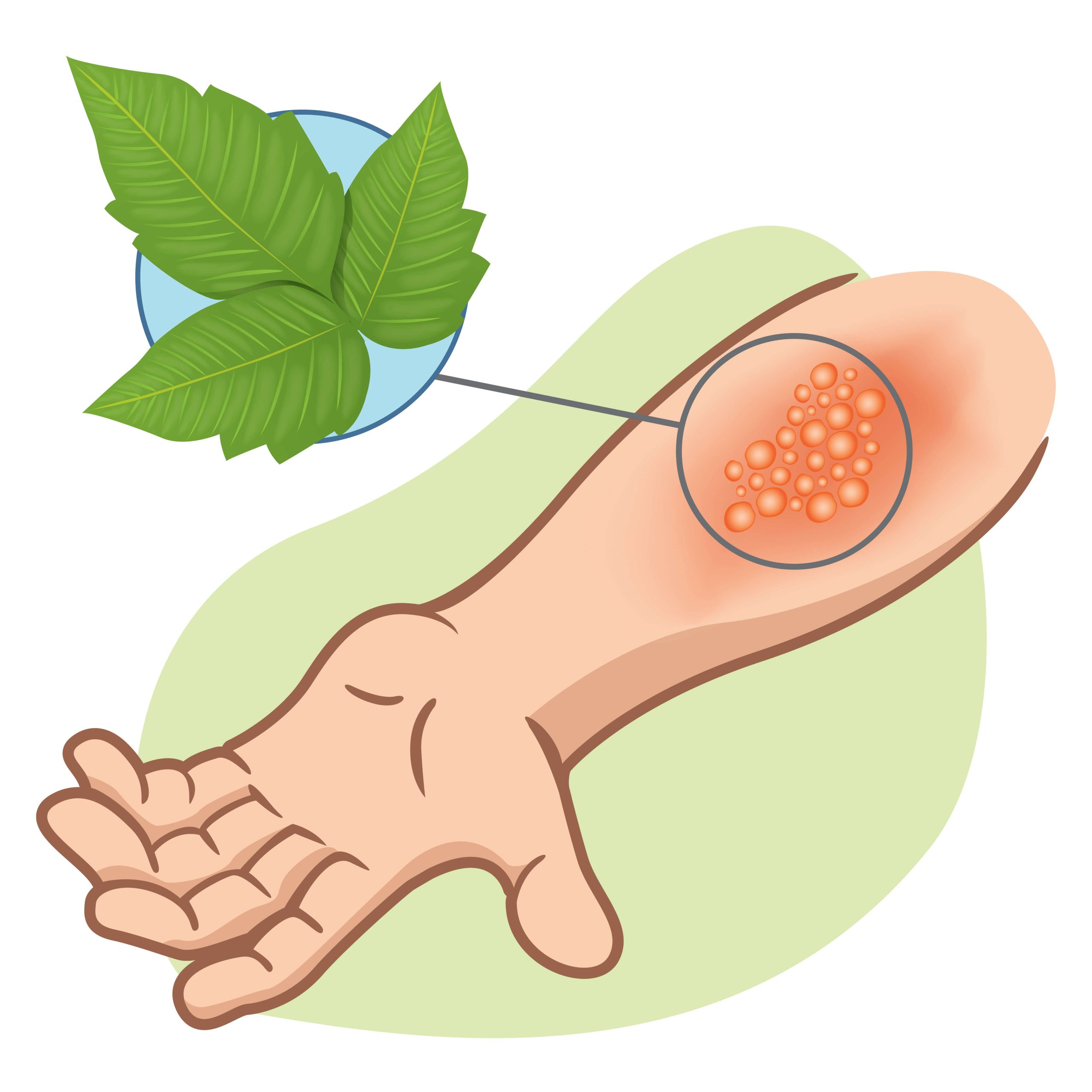 5 Myths About Poison Ivy and When to Seek Care - Velocity Urgent Care