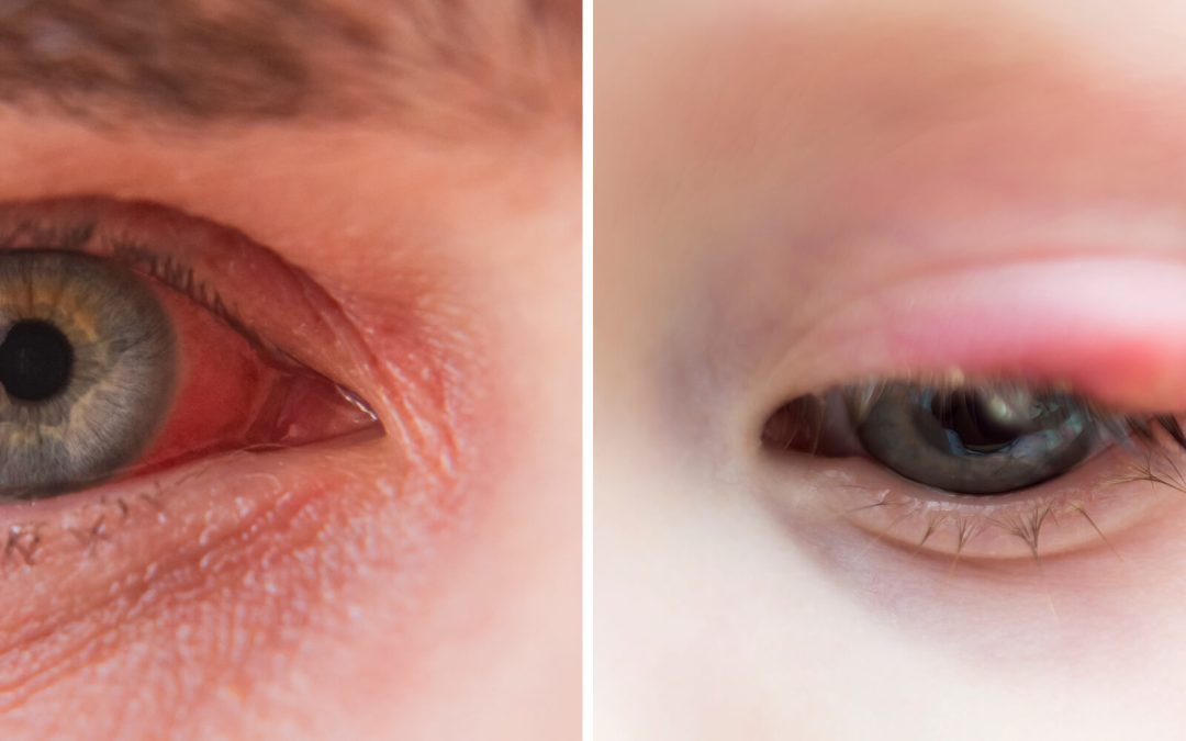 How to Tell the Difference Between a Stye and Pink Eye