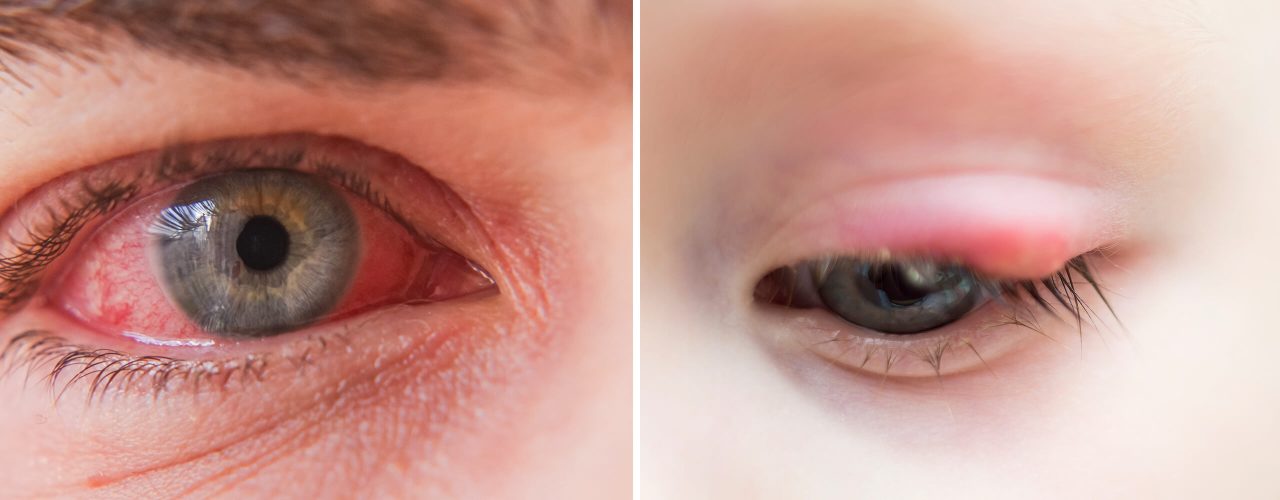 How To Tell The Difference Between A Stye And Pink Eye Velocity Urgent Care 