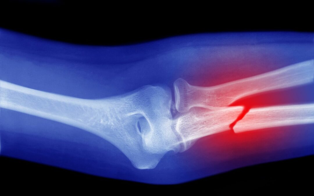 When to Go to Urgent Care for a Broken Bone: 5 Signs to Look For